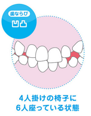歯並び凹凸