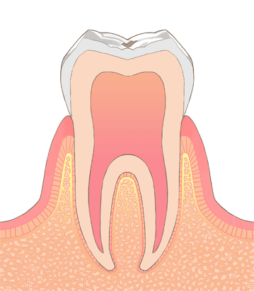 虫歯の進行c0