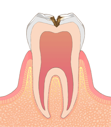 虫歯の進行c2