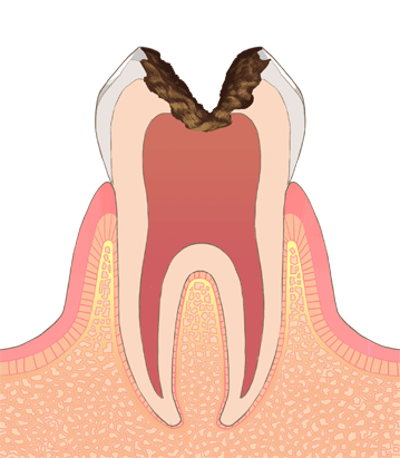 虫歯の進行c3