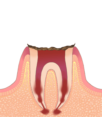 虫歯の進行c4